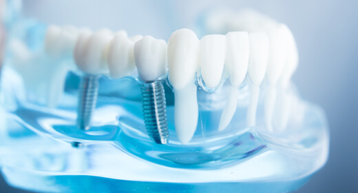 失った歯の機能をインプラント治療で取り戻しませんか？