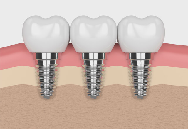 インプラント治療は失った歯を取り戻すための治療です