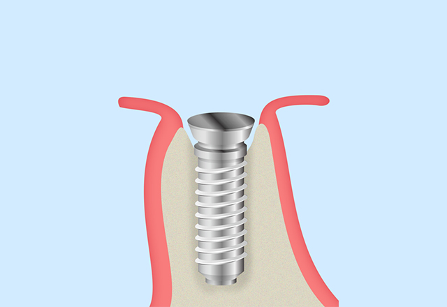 STEP 3-1 インプラントの埋め込み