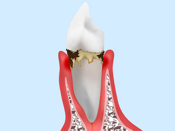 軽度歯周炎